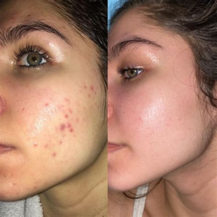 Adapalene Before and After: Transforming Skin Health with Scientific Precision