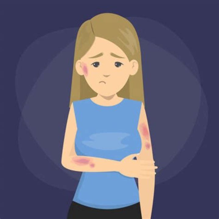 Do Hickeys Cause Cancer? Debunking the Myth and Understanding the Facts